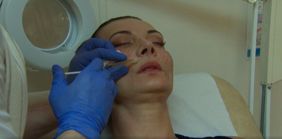 Seka waagt zich aan een vampire facelift